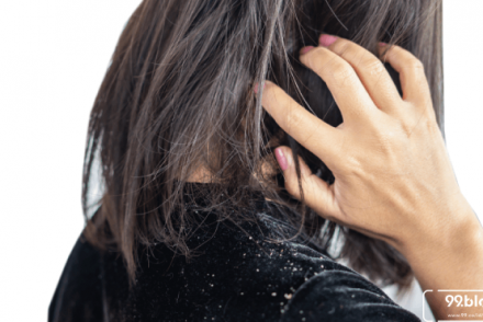 cara menghilangkan ketombe