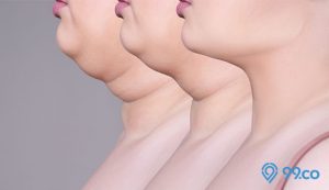 cara menghilangkan double chin