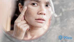 Cara Menghilangkan Flek Hitam