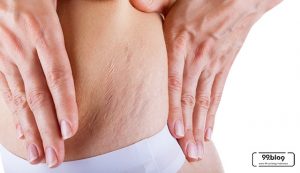 cara menghilangkan stretch mark