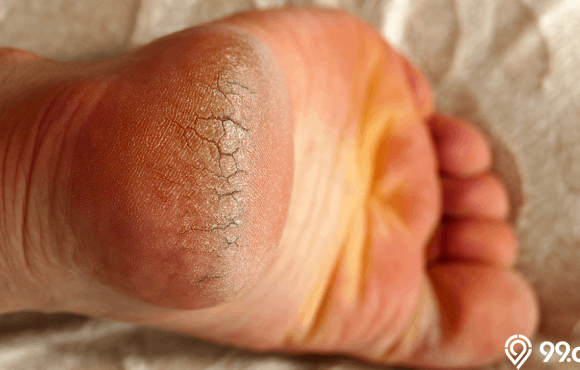 cara mengatasi kaki pecah pecah