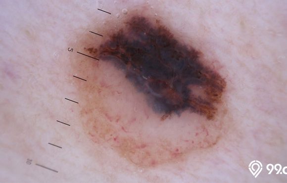 melanoma pada kulit