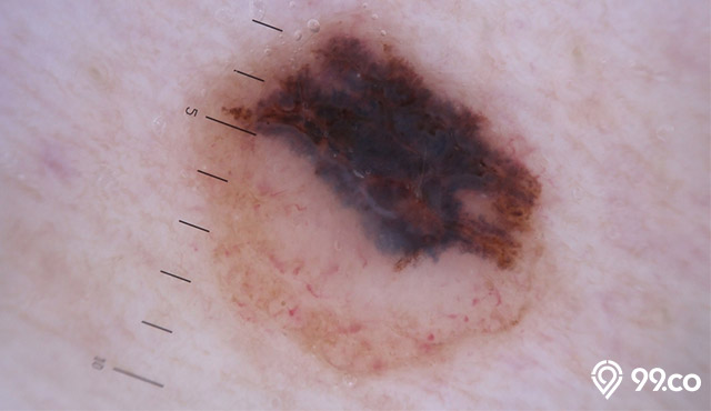 melanoma pada kulit