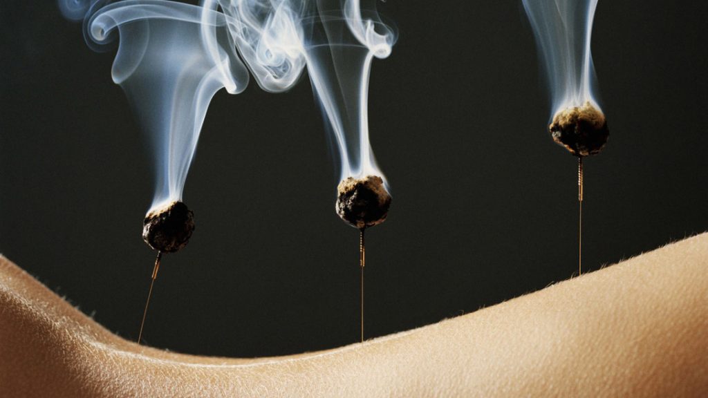 moksibusi acupuncture