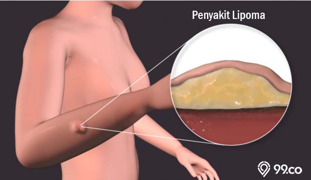 penyakit lipoma