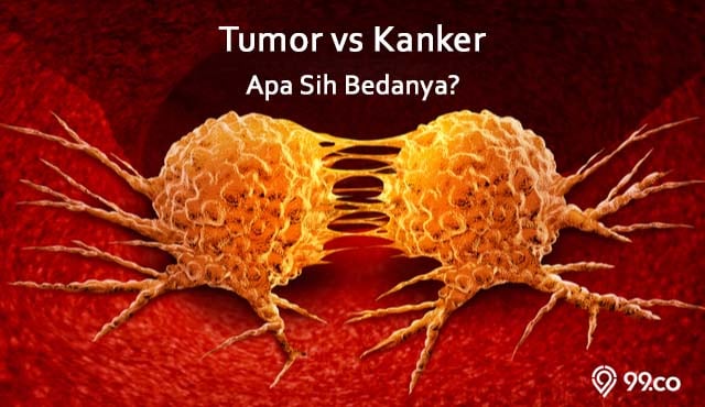 Perbedaan Kanker Dan Tumor Apa Yang Perlu Anda Ketahui