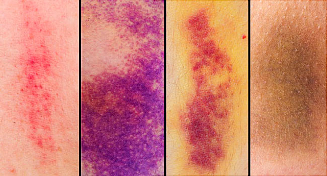 warna memar atau haematoma